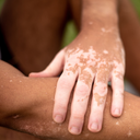 Skin Diseases, Vitiligo & Parasitic Infections